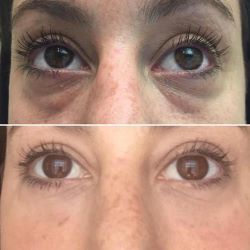 Masseur de luminothérapie rouge pour le contour des yeux