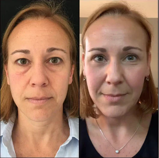 Masseur de luminothérapie rouge pour le contour des yeux