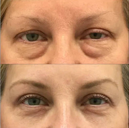 Masseur de luminothérapie rouge pour le contour des yeux