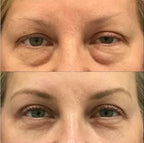 Masseur de luminothérapie rouge pour le contour des yeux