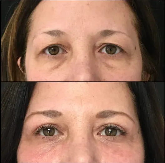 Masseur de luminothérapie rouge pour le contour des yeux